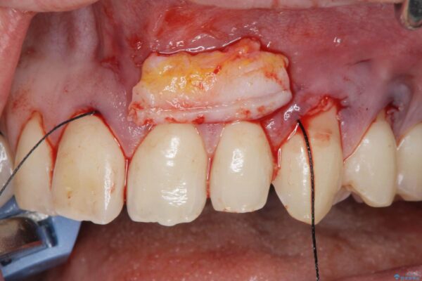 結合組織移植術にて、歯ぐきのさがりを改善[ 根面被覆 ] 治療中画像