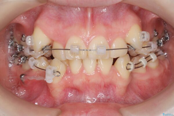 小臼歯4本抜歯 マルチブラケット矯正[ 八重歯を治す ] 治療前画像