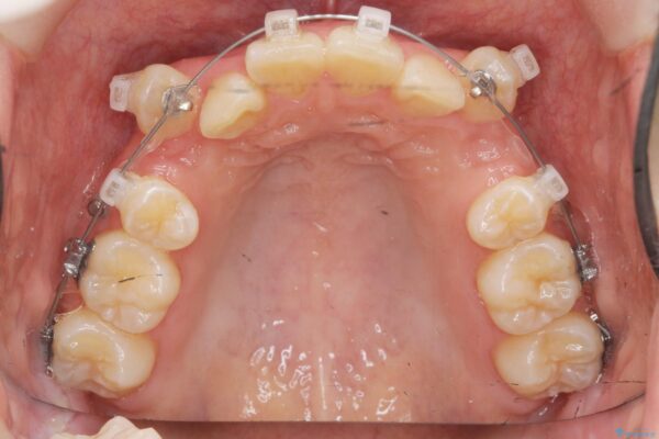 小臼歯4本抜歯 マルチブラケット矯正[ 八重歯を治す ] 治療前画像