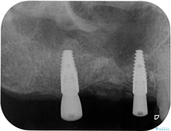 骨の造成を伴う奥歯のインプラント治療 治療中画像