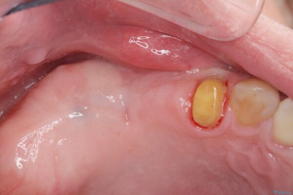 骨の造成を伴う奥歯のインプラント治療 治療中画像