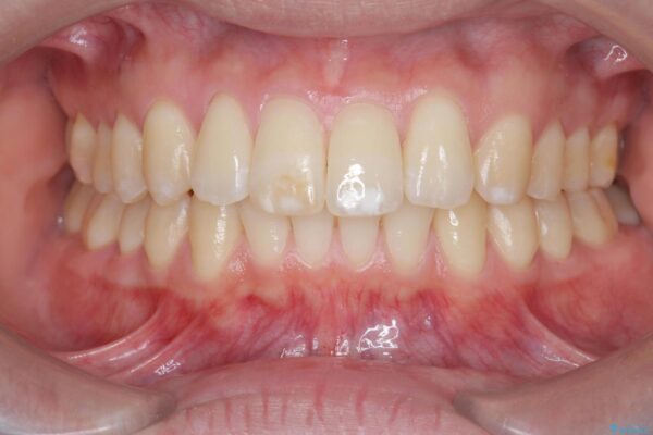 目立つ歯の隙間をマウスピース矯正で改善 アフター