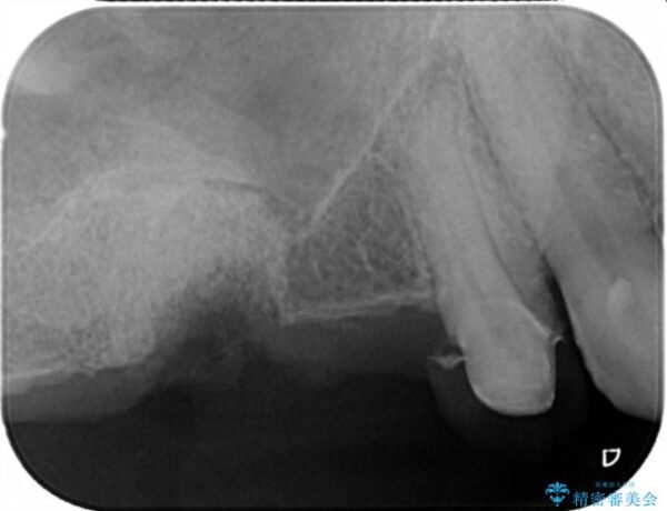 骨の造成を伴う奥歯のインプラント治療 治療前画像