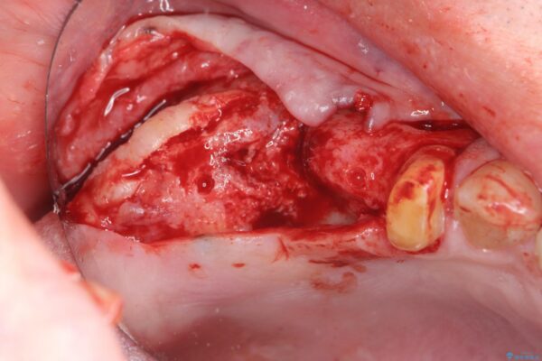 骨の造成を伴う奥歯のインプラント治療 治療中画像