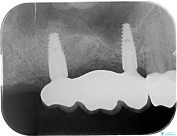 骨の造成を伴う奥歯のインプラント治療 治療後画像