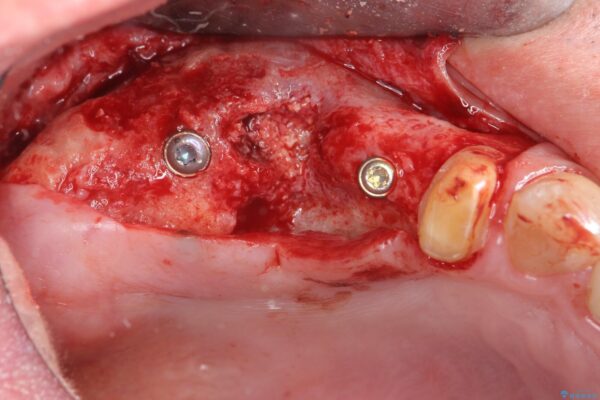 骨の造成を伴う奥歯のインプラント治療 治療中画像