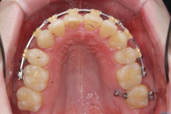 ワイヤー矯正とマウスピース矯正の併用治療[突き出た前歯を引っ込めたい] 治療中画像
