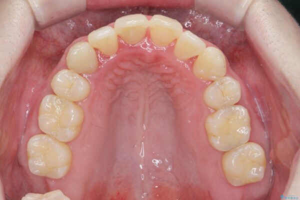 ワイヤー矯正とマウスピース矯正の併用治療[突き出た前歯を引っ込めたい] 治療後画像