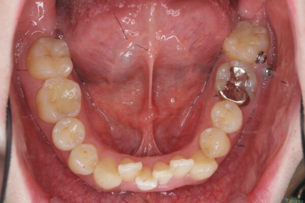 ワイヤー矯正とマウスピース矯正の併用治療[突き出た前歯を引っ込めたい] 治療中画像