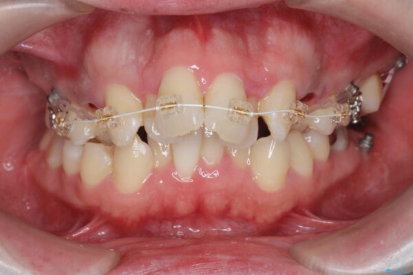 ワイヤー矯正とマウスピース矯正の併用治療[突き出た前歯を引っ込めたい] 治療前画像
