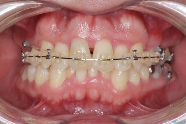 ワイヤー矯正とマウスピース矯正の併用治療[突き出た前歯を引っ込めたい] 治療中画像