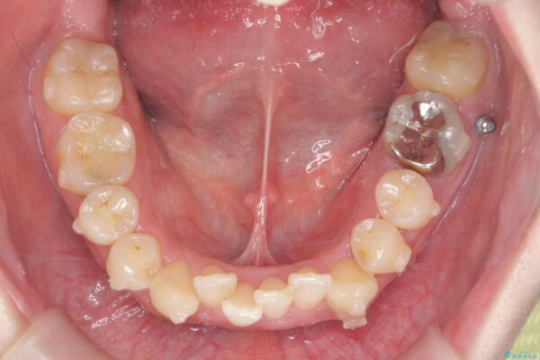 ワイヤー矯正とマウスピース矯正の併用治療[突き出た前歯を引っ込めたい] 治療中画像