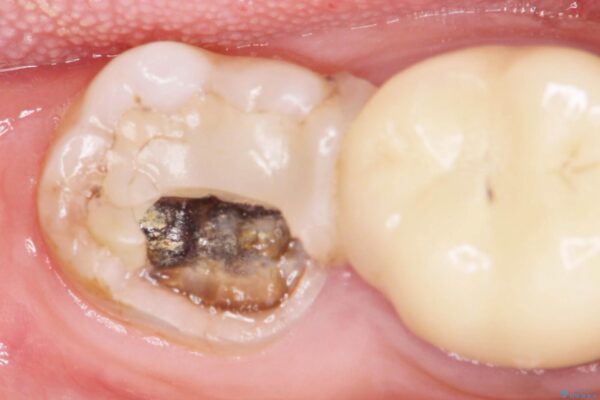 セラミッククラウンによるやり替え　インレー下に再発した虫歯 ビフォー