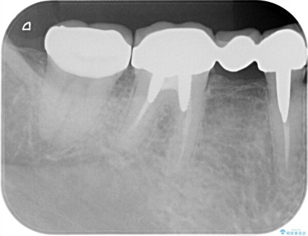 セラミッククラウンによるやり替え　インレー下に再発した虫歯 治療後画像