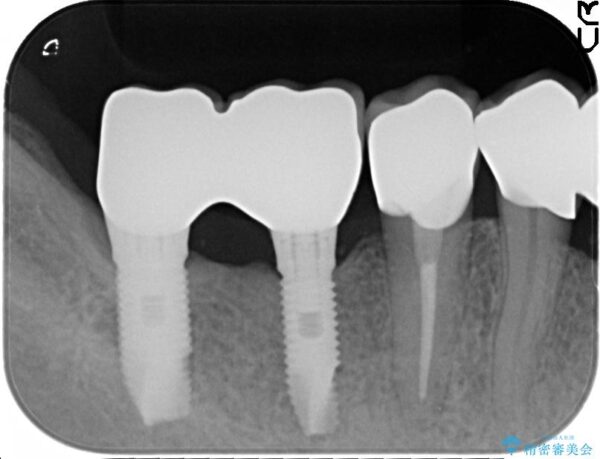 インプラント・セラミック治療を含む包括歯周病治療 治療後画像