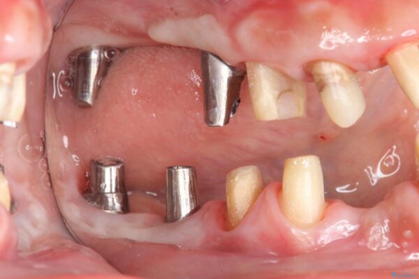 インプラント・セラミック治療を含む包括歯周病治療 治療中画像