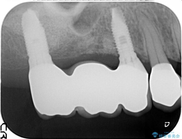 インプラント・セラミック治療を含む包括歯周病治療 治療後画像