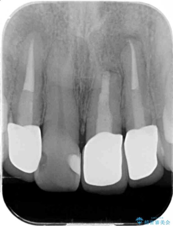 前歯のセラミック治療　前歯のフチが黒いのが気になる 治療後画像