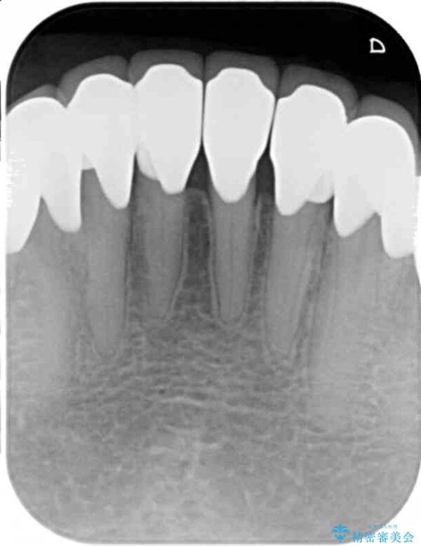 根面にできた虫歯治療[セラミッククラウン] 治療後画像