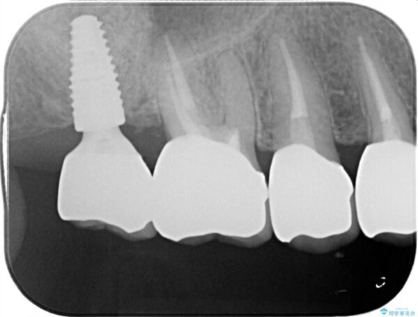 見た目の悪いクラウンをやりかえたい 治療後画像