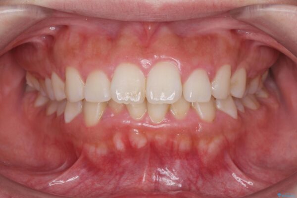 前歯のがたつき 出っ歯に見える歯をきれいに[ マウスピース矯正] ビフォー