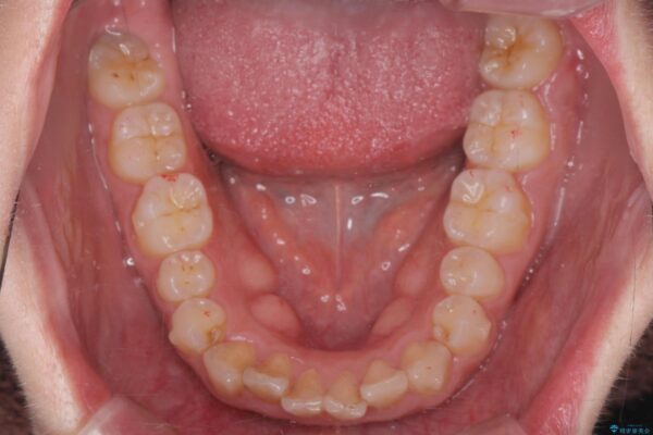 前歯のがたつき 出っ歯に見える歯をきれいに[ マウスピース矯正] 治療中画像