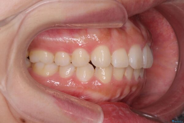 前歯のがたつき 出っ歯に見える歯をきれいに[ マウスピース矯正] 治療後画像