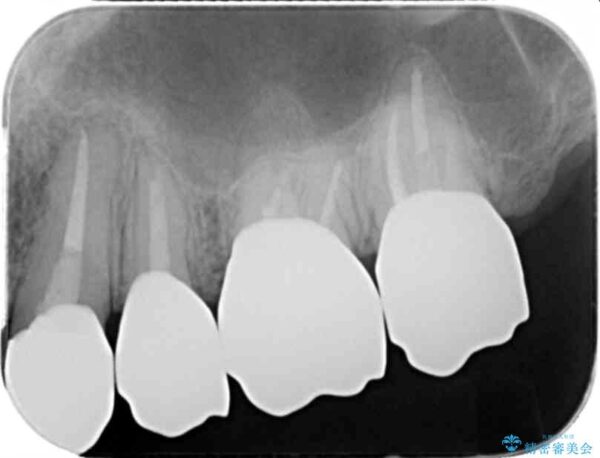 虫歯だらけの歯を治療したい 治療後画像