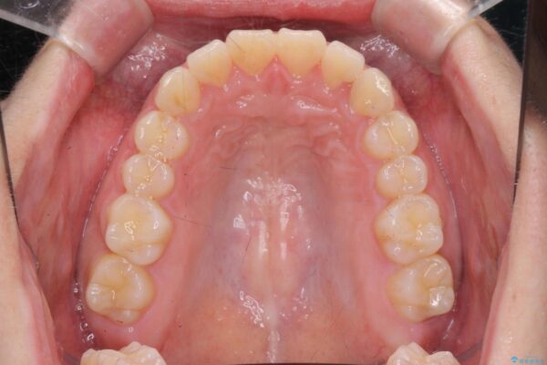 前歯のがたつき 出っ歯に見える歯をきれいに[ マウスピース矯正] 治療後画像