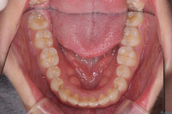 前歯のがたつき 出っ歯に見える歯をきれいに[ マウスピース矯正] 治療後画像
