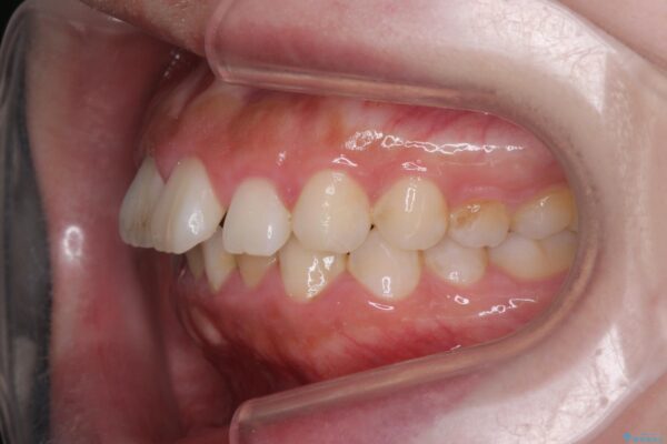 前歯のがたつき 出っ歯に見える歯をきれいに[ マウスピース矯正] 治療前画像