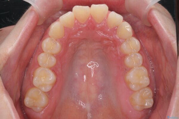 前歯のがたつき 出っ歯に見える歯をきれいに[ マウスピース矯正] 治療前画像