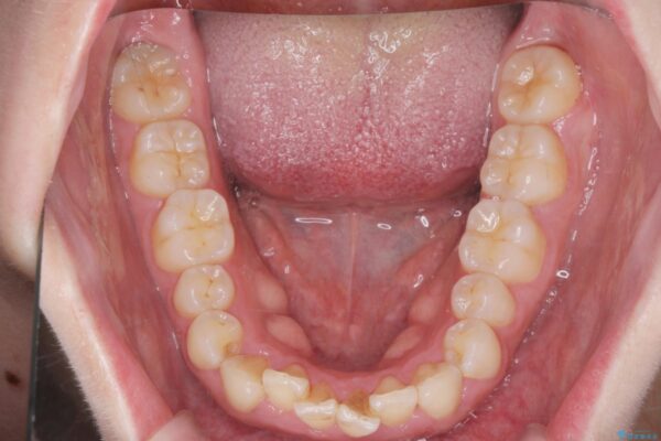 前歯のがたつき 出っ歯に見える歯をきれいに[ マウスピース矯正] 治療前画像