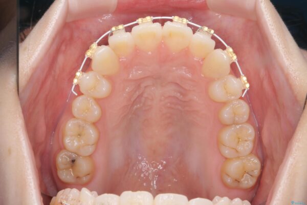 前歯のねじれをきれいに 部分ワイヤー+マウスピース矯正 治療前画像