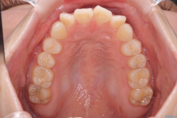 前歯のねじれをきれいに 部分ワイヤー+マウスピース矯正 治療前画像