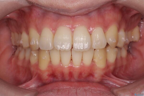 気になる犬歯のガタつきをマウスピース矯正で改善 治療中画像