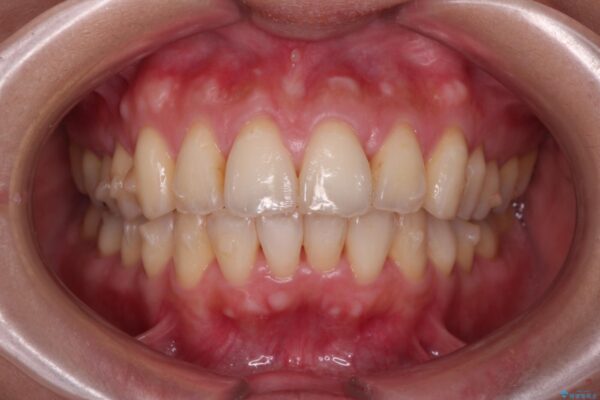 上下前歯のガタつきをインビザラインで改善 治療中画像