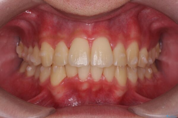 気になる出っ歯、インビザラインで改善 治療中画像