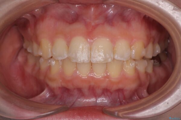 前歯の隙間と口元の突出感を改善したい 治療中画像