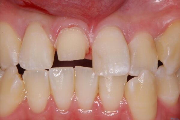 保険のかぶせ物の色が気になる 治療中画像