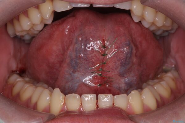 舌小帯を切除し滑舌を治したい 治療中画像