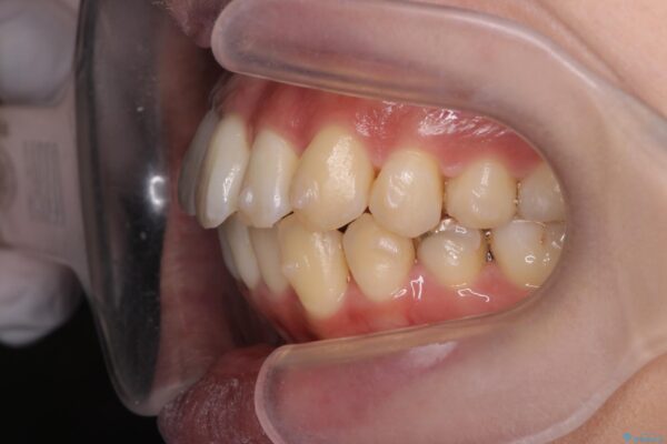 気になる犬歯のガタつきをマウスピース矯正で改善 治療中画像