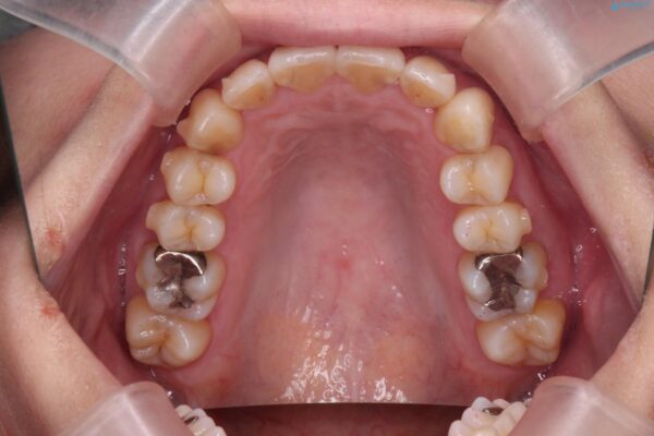 上下前歯のガタつきをインビザラインで改善 治療中画像