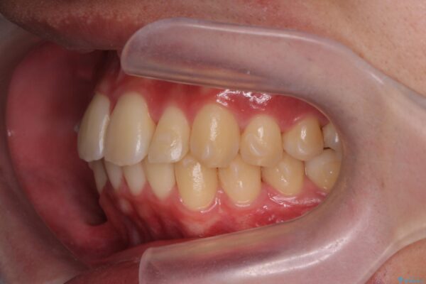 気になる出っ歯、インビザラインで改善 治療中画像