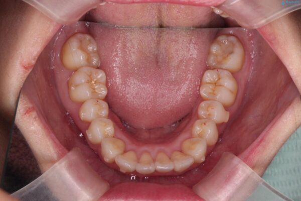 上下前歯のガタつきをインビザラインで改善 治療中画像