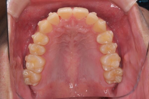 気になる出っ歯、インビザラインで改善 治療中画像