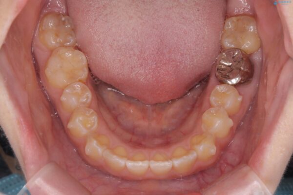 前歯の隙間と口元の突出感を改善したい 治療中画像