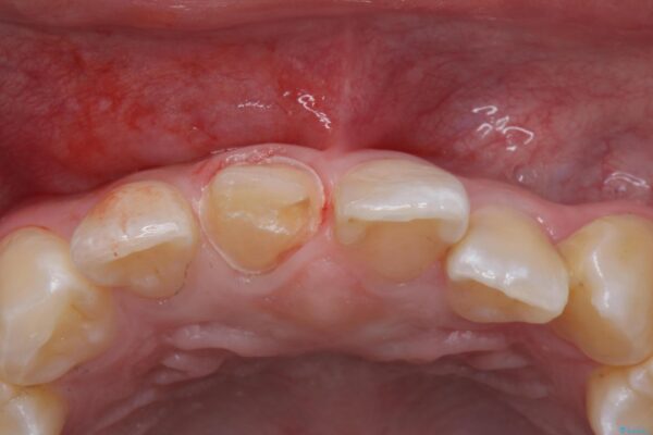 保険のかぶせ物の色が気になる 治療中画像