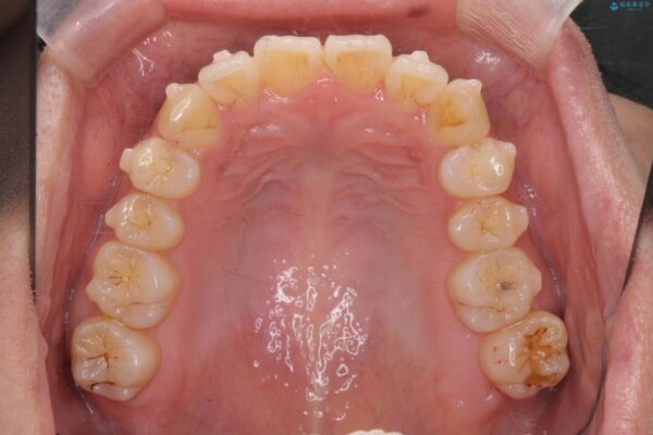 気になる犬歯のガタつきをマウスピース矯正で改善 治療中画像
