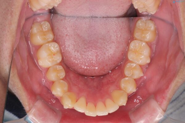 気になる出っ歯、インビザラインで改善 治療中画像